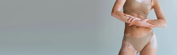 Çamaşırlı Vitiligo Derili Gri Pankartta Tek Başına Duran Poz Veren — Stok fotoğraf