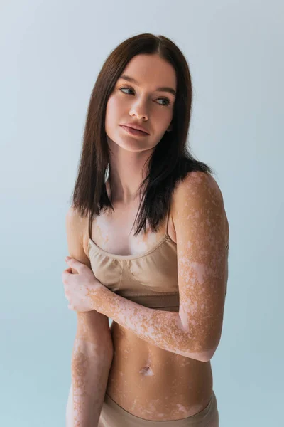 Modelo Joven Con Vitiligo Pie Sujetador Superior Beige Mirando Hacia —  Fotos de Stock