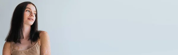 Модель Брюнетки Витилиго Стоя Бежевом Верхнем Бюстгальтере Глядя Сторону Изолированы — стоковое фото