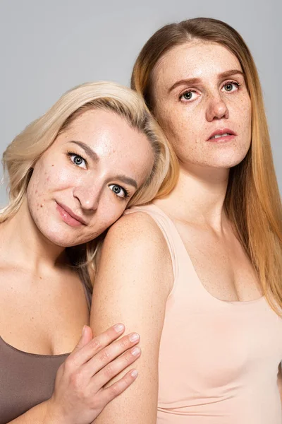 Portret Kobiety Problemami Skórnymi Stojącej Patrzącej Kamerę Odizolowanej Szaro — Zdjęcie stockowe