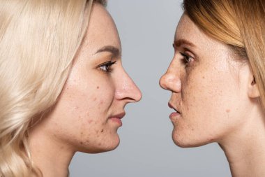 profile of women with problem skin standing face to face isolated on grey  clipart