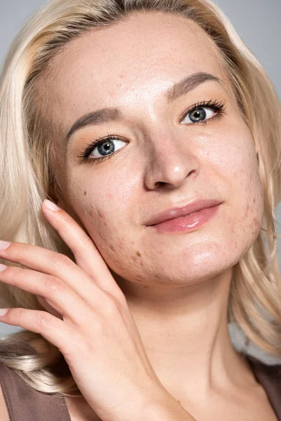 Närbild Blond Kvinna Med Akne Huden Isolerad Grå — Stockfoto