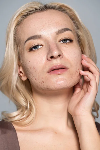Portret Pięknej Blondynki Problematyczną Skórą Dotykającą Policzka Odizolowanej Szaro — Zdjęcie stockowe