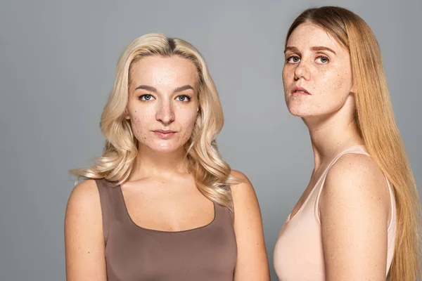 Modeller Med Hudproblem Tittar Kameran Medan Står Isolerad Grå — Stockfoto
