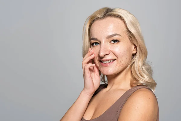 Lächelnde Frau Mit Akne Gesicht Berührt Wange Isoliert Auf Grau — Stockfoto