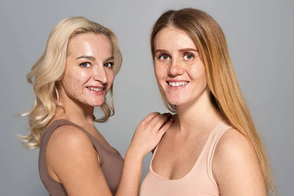 Unbekümmerte Frauen Mit Hautproblemen Blicken Isoliert Auf Graue Kamera — Stockfoto