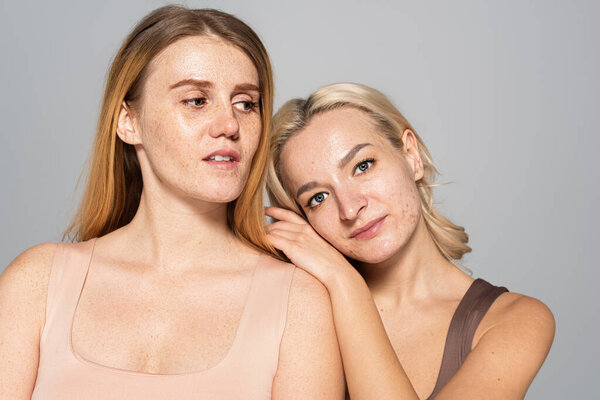 Freckled woman standing near friend with acne on face isolated on grey 