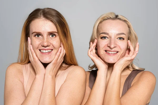 Positive Freunde Mit Problemhaut Berühren Gesicht Isoliert Auf Grau — Stockfoto
