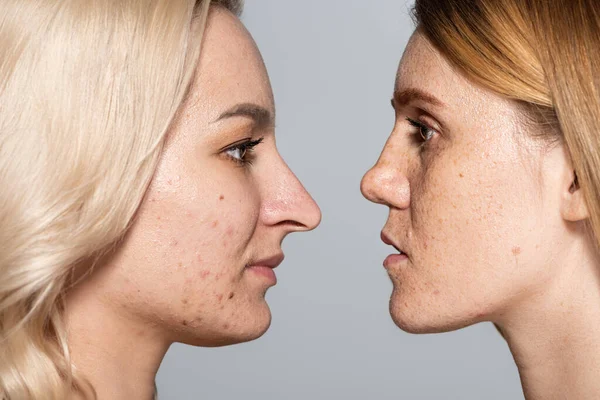 Perfil Mulheres Com Problema Pele Face Face Isoladas Cinza — Fotografia de Stock