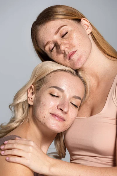 Freckled woman hugging friend with problem skin and closed eyes isolated on grey