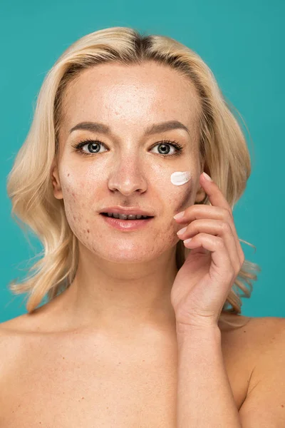 blonde woman with acne applying cream on face isolated on turquoise