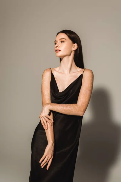 Hübsche junge Frau mit Vitiligo posiert im schwarzen Kleid auf grauem Hintergrund — Stockfoto