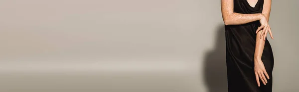 Обрізаний вид жінки з вітіліго торкається руки на сірому фоні з тіні, банер — стокове фото