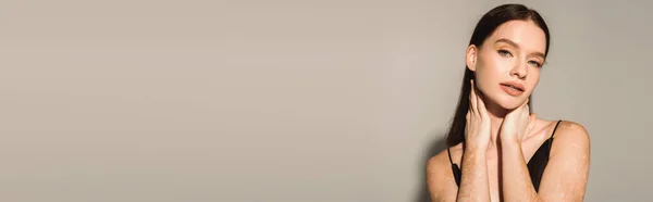 Mulher bonita com vitiligo tocando pescoço no fundo cinza com sombra, banner — Fotografia de Stock