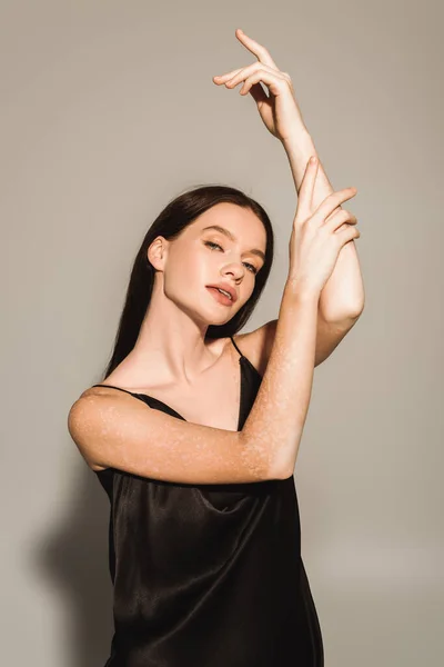 Jeune femme élégante avec vitiligo toucher le bras et regarder la caméra sur fond gris — Photo de stock