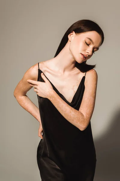 Pretty young woman with vitiligo touching black silk dress on grey background — Stock Photo