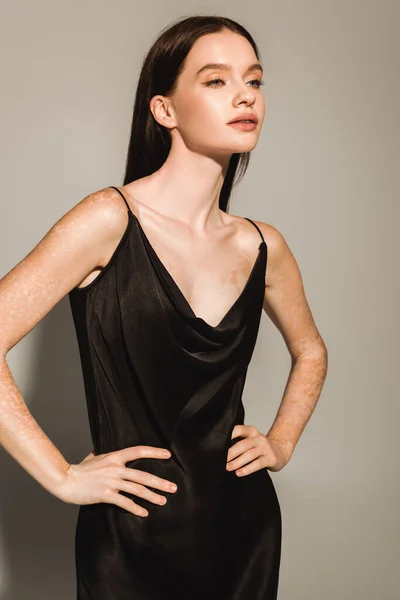 Mulher na moda com vitiligo de mãos dadas nos quadris enquanto posando em vestido no fundo cinza — Fotografia de Stock