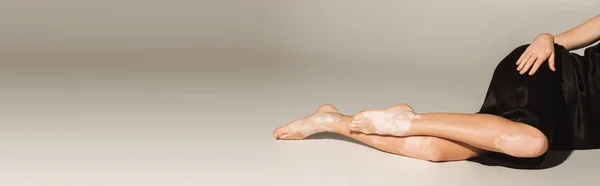 Vista cortada de jovem com vitiligo deitado sobre fundo cinza, banner — Fotografia de Stock