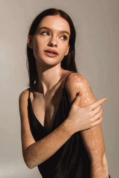 Портрет красивої жінки з вітіліго, що торкається плеча, ізольовано на сірому зі світлом — стокове фото