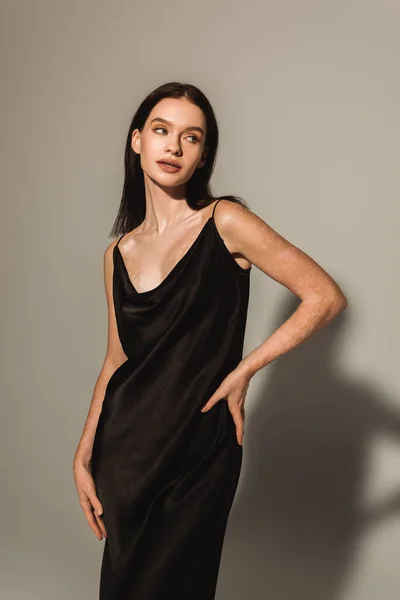 Modelo elegante com vitiligo em vestido de seda preta de pé com a mão no quadril no fundo cinza — Fotografia de Stock