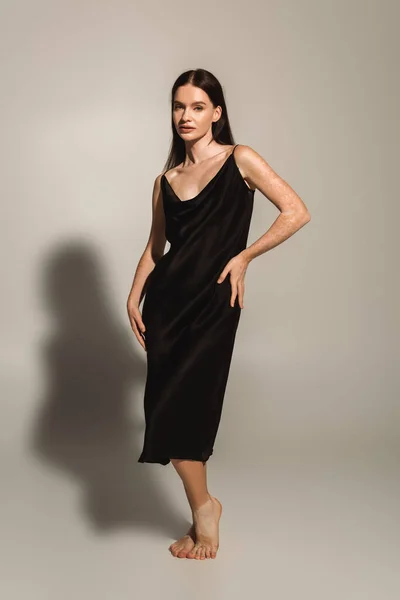Elegante donna con vitiligine toccante anca mentre posa in abito di raso su sfondo grigio — Foto stock