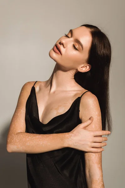 Mujer bonita con vitiligo cerrando los ojos y tocando el brazo sobre fondo gris - foto de stock