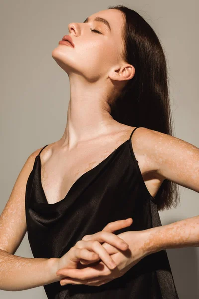 Bonita modelo con vitiligo posando en vestido de seda sobre fondo gris - foto de stock