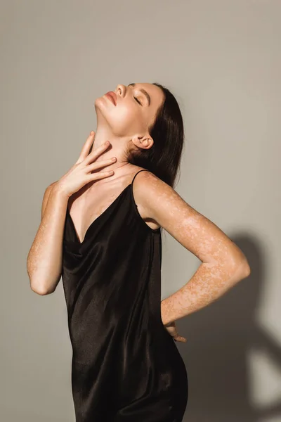 Trendy young woman with vitiligo touching neck on grey background — Stock Photo