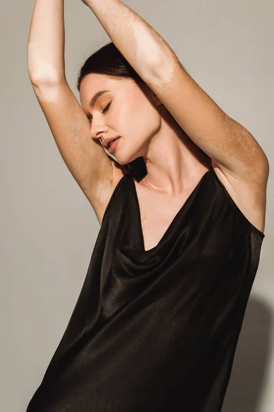 Чуттєва модель з вітіліго позує в чорній сукні на сірому фоні — стокове фото