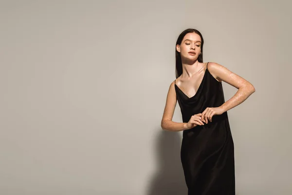 Модная женщина с витилиго позирует в черной камизоле на сером фоне — стоковое фото