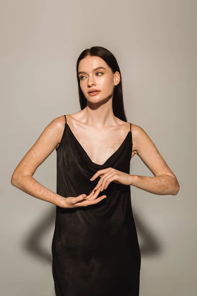 Stilvolles Modell mit Vitiligo posiert in schwarzem Kleid und berühren Hände auf grauem Hintergrund mit Schatten — Stockfoto