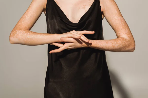 Vista recortada de mujer con vitiligo tocando las manos sobre fondo gris - foto de stock
