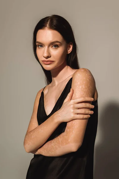 Portrait de modèle brune avec vitiligo en robe satinée regardant la caméra sur fond gris — Photo de stock