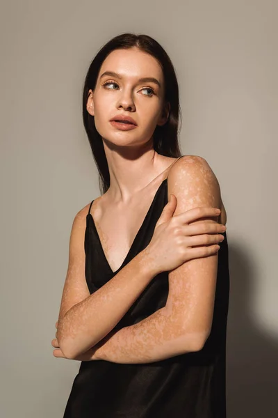Mulher bonita com vitiligo posando em vestido de cetim e olhando para o fundo cinza — Fotografia de Stock