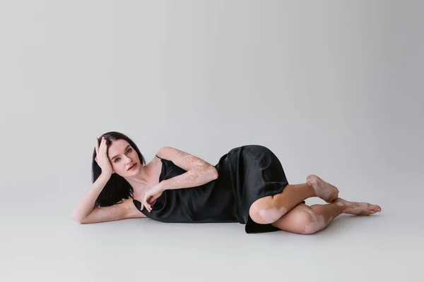 Mujer bonita y descalza con vitiligo acostado sobre fondo gris - foto de stock