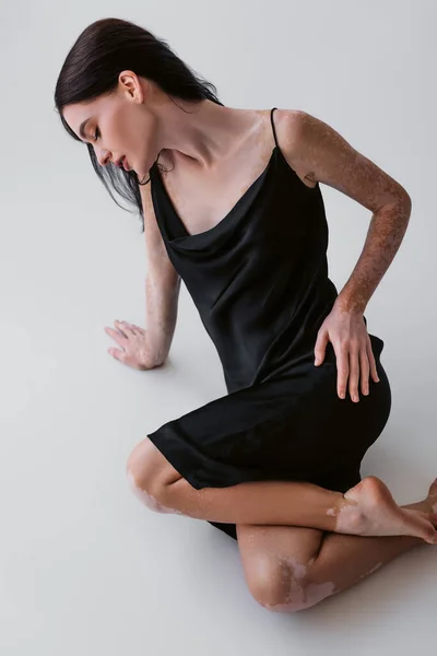 Vue grand angle de femme sensuelle avec vitiligo posant en robe sur fond gris — Photo de stock