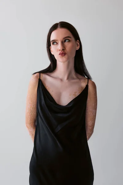 Femme brune avec des lèvres vitiligo boudantes et regardant loin isolé sur gris — Photo de stock