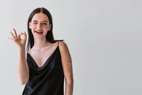 Lächelnde Frau mit Vitiligo zeigt ok Geste und zwinkert in die Kamera isoliert auf grau — Stockfoto