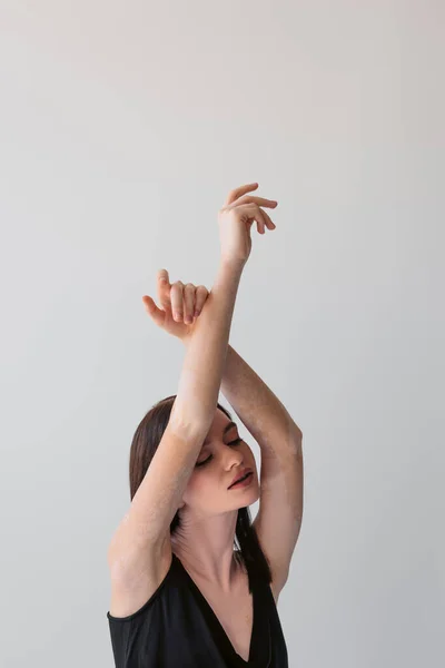 Mujer joven bonita con vitiligo levantando las manos y cerrando los ojos aislados en gris - foto de stock