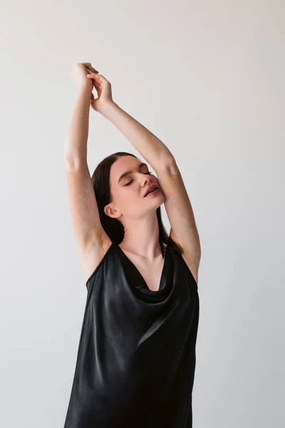 Modelo sensual con vitiligo levantando manos aisladas sobre gris - foto de stock