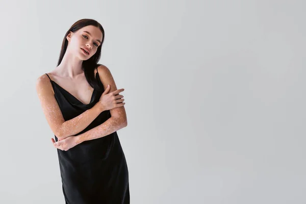 Mulher bonita com vitiligo no vestido de cetim tocando os braços e olhando para a câmera isolada no cinza — Fotografia de Stock
