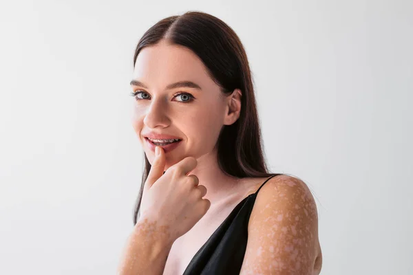 Portrait de jolie femme avec lèvres vitiligo touchantes et souriant à la caméra isolé sur gris — Photo de stock