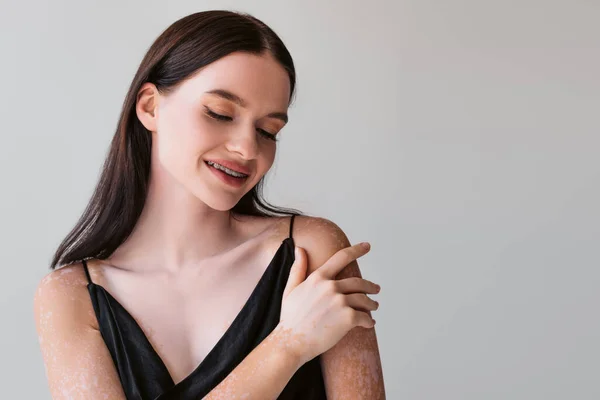 Mujer joven bonita con vitiligo y frenos tocando hombro y sonriendo aislado en gris - foto de stock