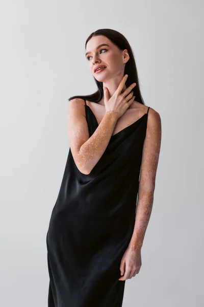 Modelo positivo com vitiligo tocando pescoço enquanto posando em vestido isolado em cinza — Fotografia de Stock