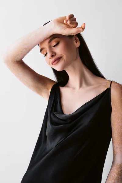 Bonito modelo con vitiligo posando en vestido de seda negro aislado en gris - foto de stock