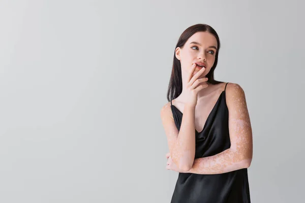 Bonita modelo con vitiligo tocando los labios y mirando hacia otro lado aislado en gris - foto de stock