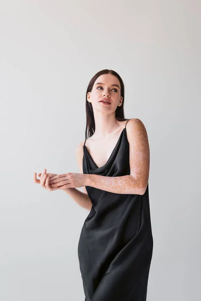 Чуттєва жінка з вітіліго позує в чорному атласному платті ізольовано на сірому — стокове фото