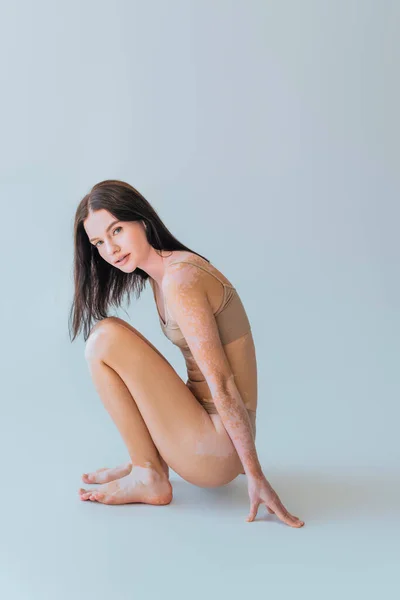 Brunette woman with vitiligo sitting in beige bra top with panties on grey — Stock Photo