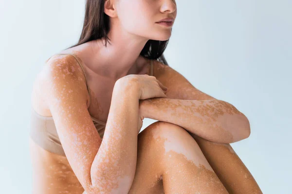 Cropped view of model with vitiligo skin condition sitting isolated on grey — Stock Photo