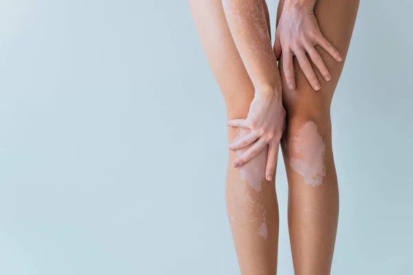 Abgeschnittene Ansicht des Modells mit Vitiligo chronischen Hautzustand posiert isoliert auf grau — Stockfoto